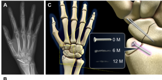 몸에 녹는 금속 나사, 골절치료 분야 새로운 장 열어
